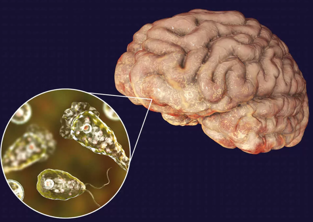 amoebic meningoencephalitis