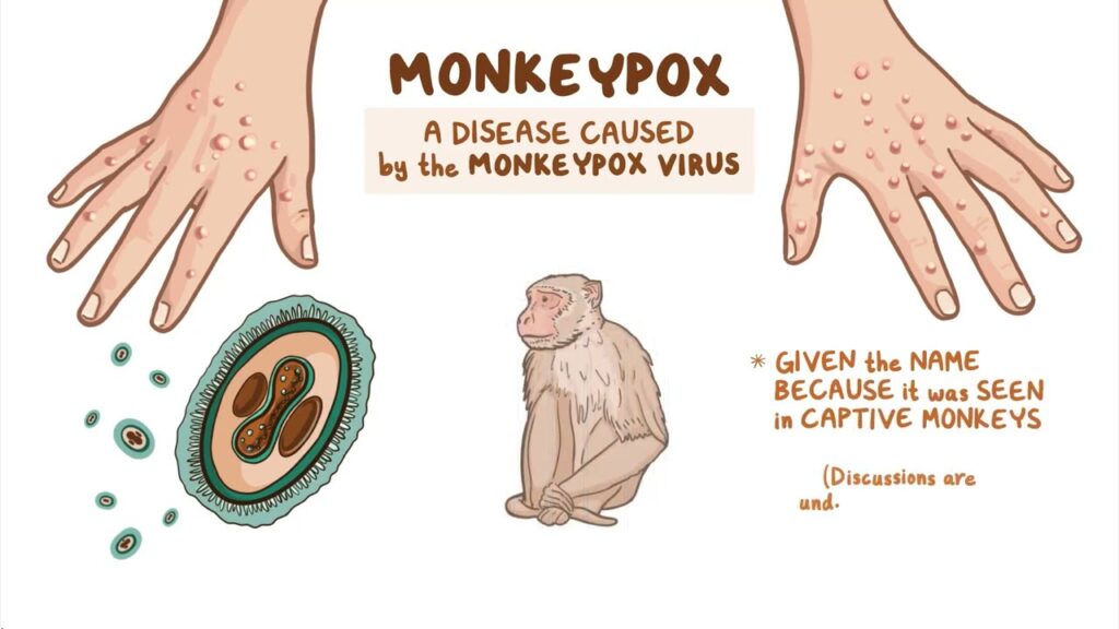 monkeypox